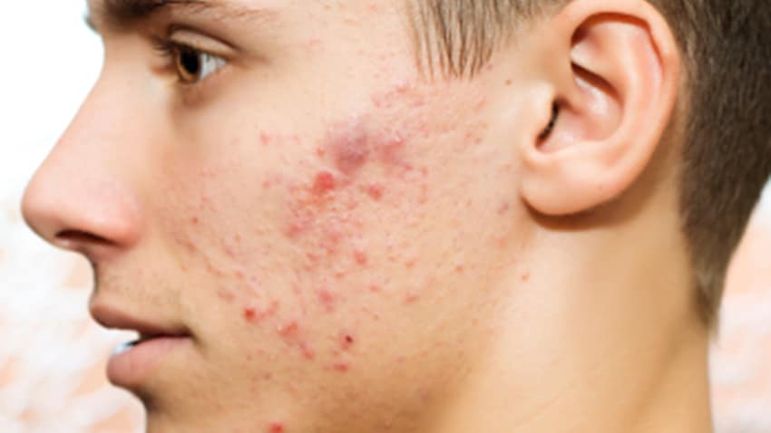 What the Causes of Acne and How to Handle It by Yourself